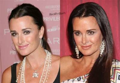 All About Rhobh Kyle Richards Plastic Surgery with Before and After Photos