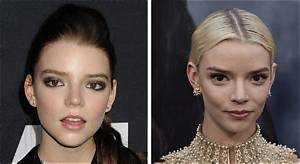 Anya Taylor-Joy’s Plastic Surgery: Did the Menu Cast Have Blepharoplasty, Brow Lift, and Buccal Fat Removal?