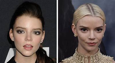 Anya Taylor-Joy’s Plastic Surgery: Did the Menu Cast Have Blepharoplasty, Brow Lift, and Buccal Fat Removal?