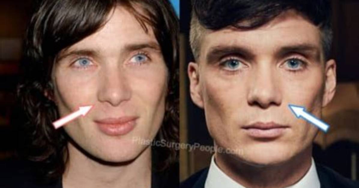 Cillian Murphy Nose: Did He Underwent Surgery? Before and After Pics