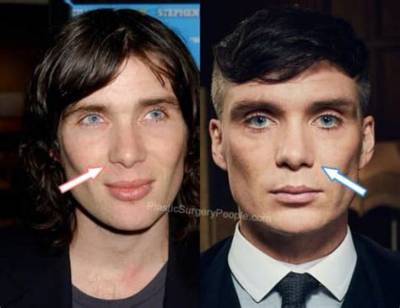 Cillian Murphy Nose: Did He Underwent Surgery? Before and After Pics