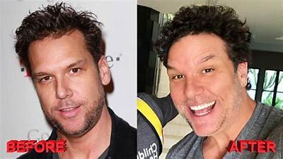 Did Dane Cook Undergo Plastic Surgery? What Happened to His Face? Before and After Photos