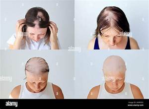 Does Nicolas Roman Strut Have Cancer? Alopecia Universalis Disease & Health Condition