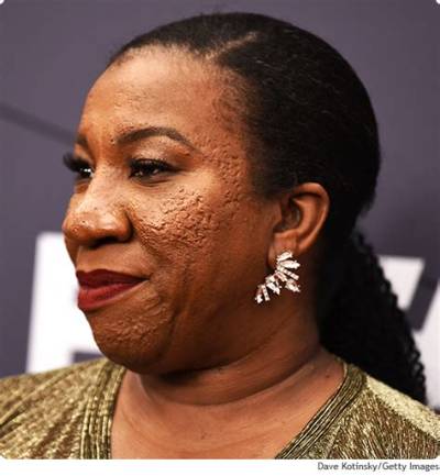 Does Tarana Burke Have a Skin Condition? What Happened to Her Face?