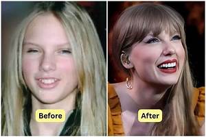 Does Taylor Swift Have Fake Teeth? or Did She Get Veneers?