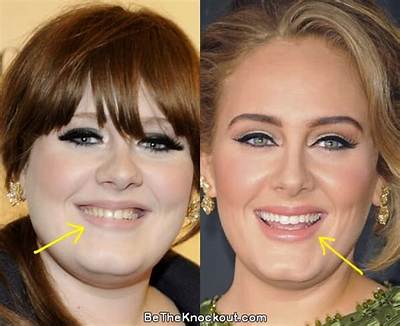 Fact Check: Has Adele Had Her Teeth Done?