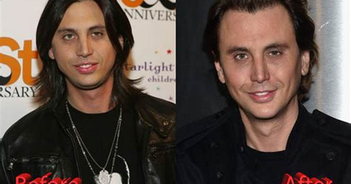 “Foodgod” Aka Jonathan Cheban Face Before Surgery and Does He Have a Glass Eye? Rumors Explored