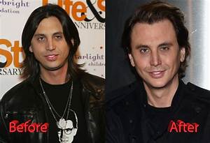 “Foodgod” Aka Jonathan Cheban Face Before Surgery and Does He Have a Glass Eye? Rumors Explored