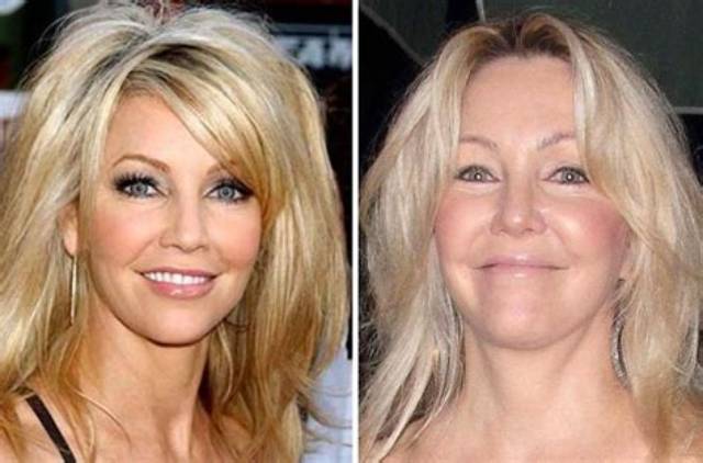 Heather Locklear Face Lift and Plastic Surgery – Weight Gain Explained