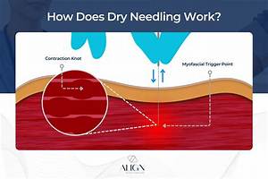 How Does Dry Needling Work