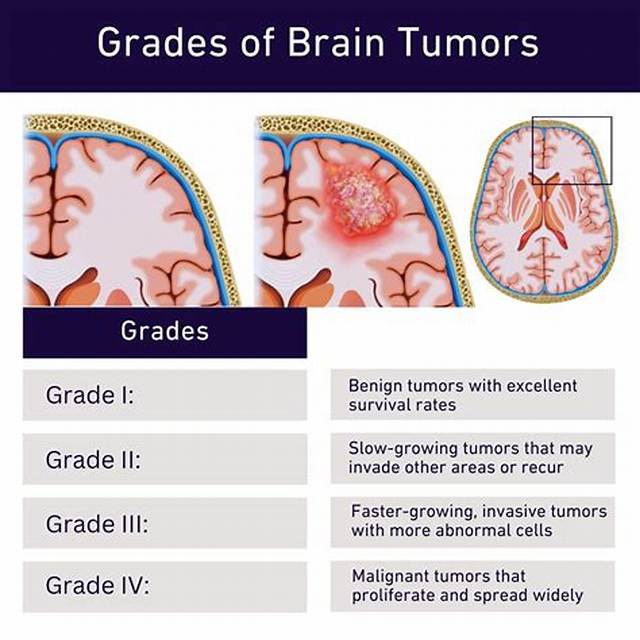 How Fast Do Brain Tumors Grow