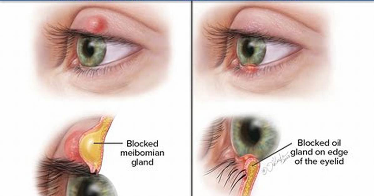 How Long Does a Chalazion Take to Drain