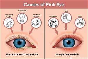 How to Know If Pink Eye Is Healing
