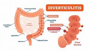How to Pronounce Diverticulitis