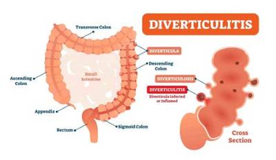 How to Pronounce Diverticulitis