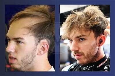 Is Pierre Gasly Bald Now? What Happened to His Hair? Health Update