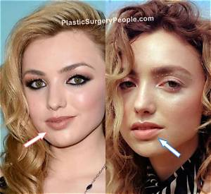 Peyton List Plastic Surgery: Before and After Photos