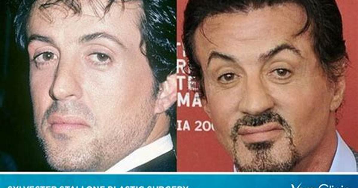 Sylvester Stallone Heart Surgery: Did He Get a Stroke? Health Update