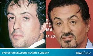Sylvester Stallone Heart Surgery: Did He Get a Stroke? Health Update