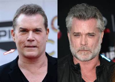 What Happened to Ray Liotta Face? Had He Done the Plastic Surgery