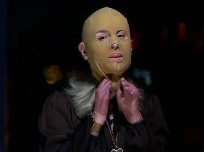 What Happened to Stephanie Browitt Face? 60 Minutes Unmask the Story of White Island Volcano Survivor