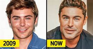 What Happened to Zac Efron Face After Car Accident: Jaw Injury Update, Before & After Plastic Surgery