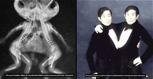 What Happens If One Conjoined Twin Dies