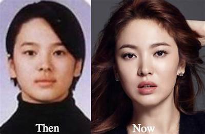 Youtuber: Song Jia Before & Plastic Surgery – Her Transformation Exposed